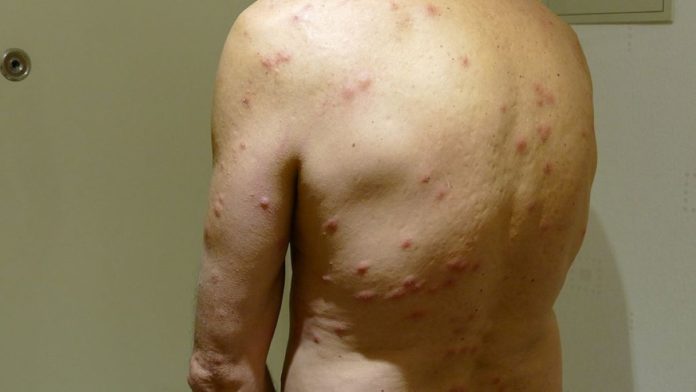2015.11.26.192558_Cimex_lectularius_bites Chicago Takes Another Top Spot for Pests, This Time Ranking #1 on Orkin's Bed Bug Cities List